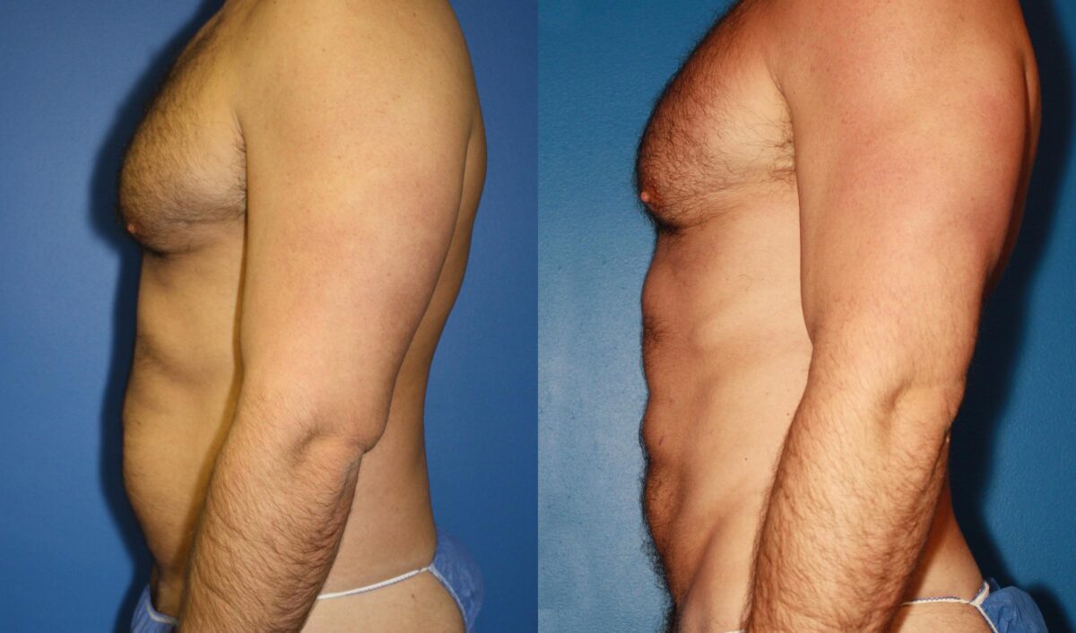 Daddy Do Over Before and After Photos in New York, NY, Patient 13643