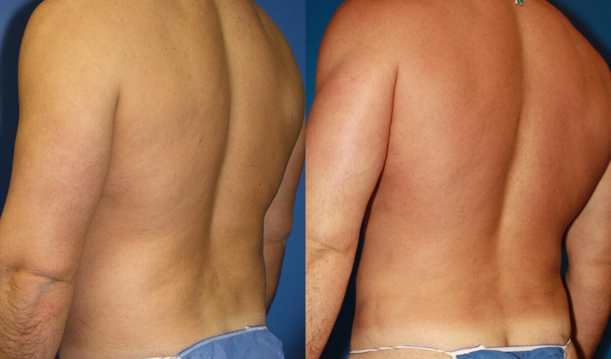 Daddy Do Over Before and After Photos in New York, NY, Patient 13643