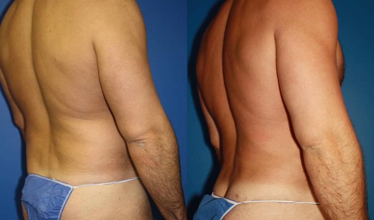 Daddy Do Over Before and After Photos in New York, NY, Patient 13643