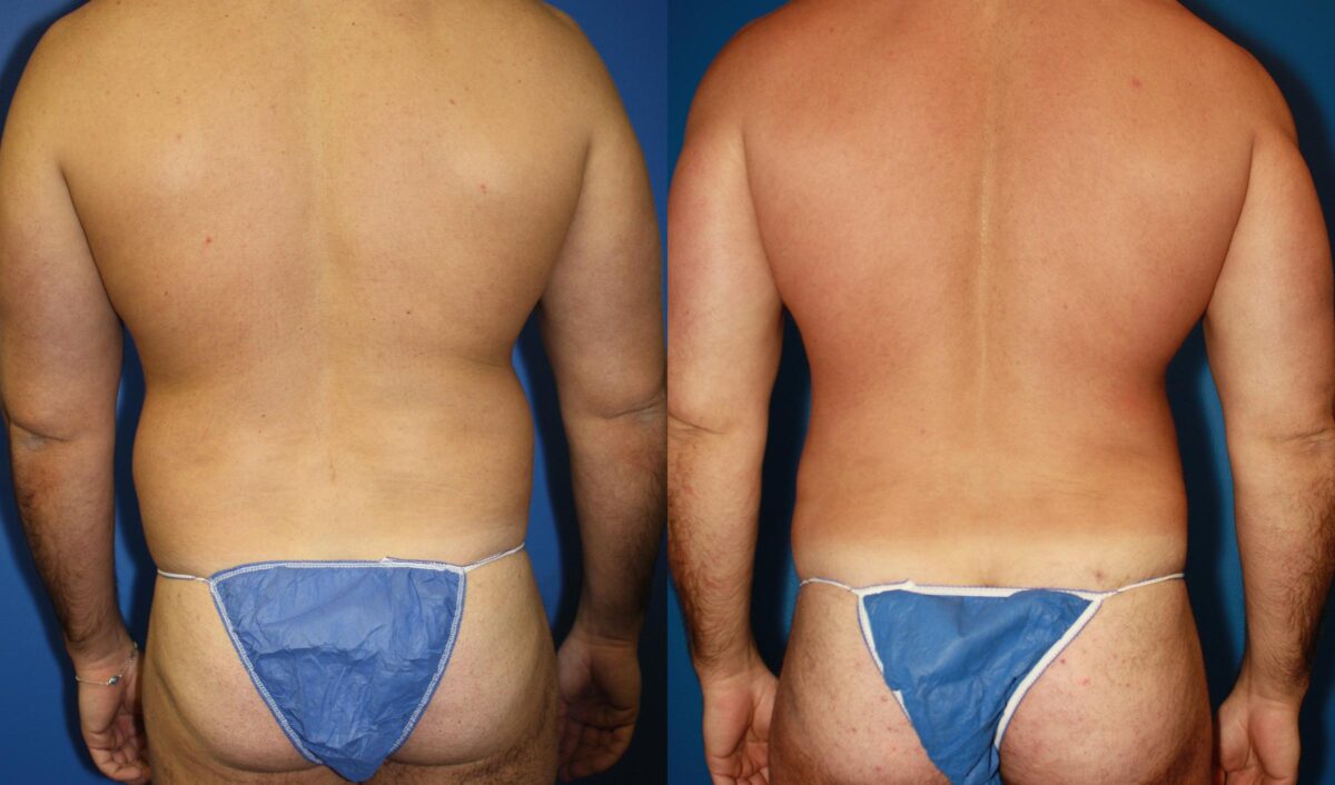 Daddy Do Over Before and After Photos in New York, NY, Patient 13643
