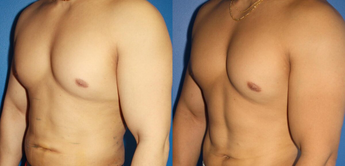 Hi-Def Liposuction Before and After Photos in New York, NY, Patient 13672