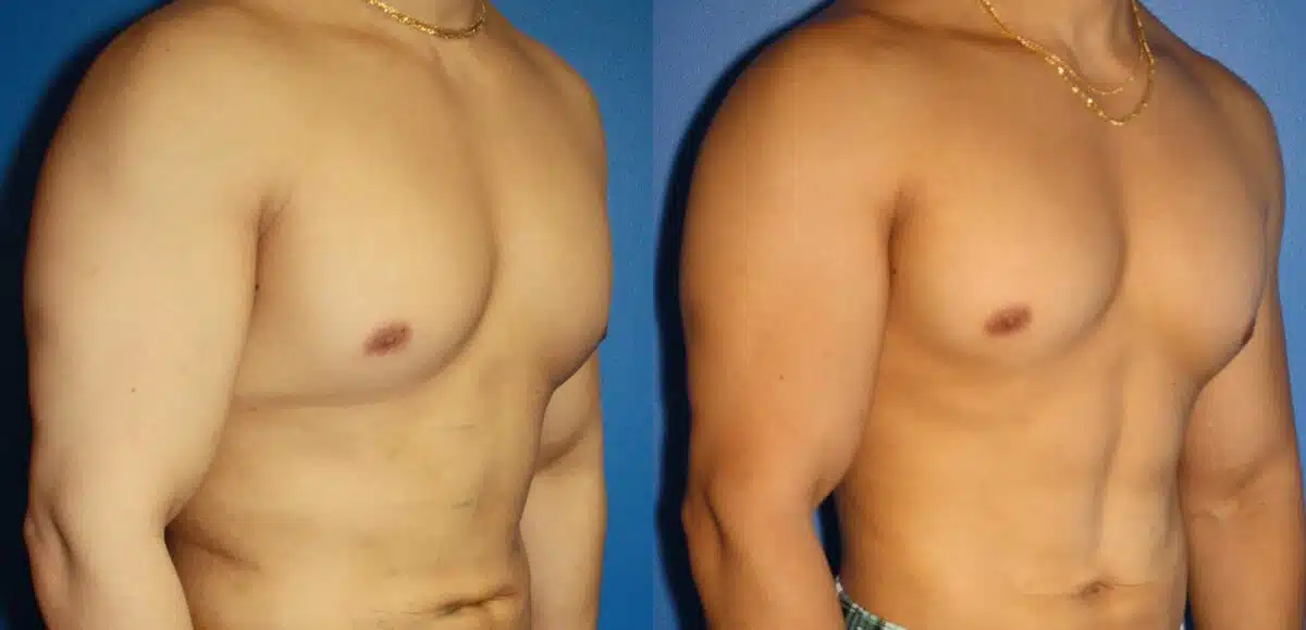 Hi-Def Liposuction Before and After Photos in New York, NY, Patient 13672