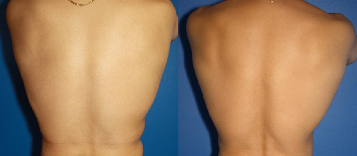 Hi-Def Liposuction Before and After Photos in New York, NY, Patient 13672