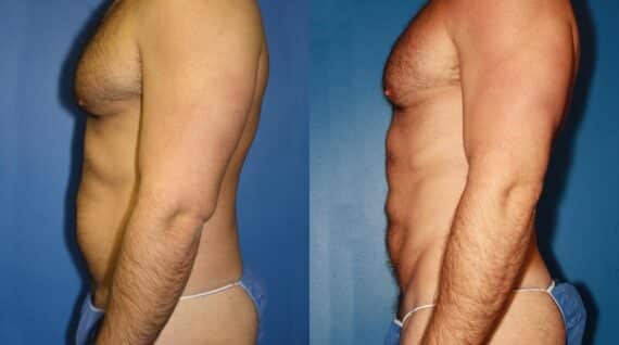 Gluteal Augmentation Before and After Photos in New York, NY, Patient 13690