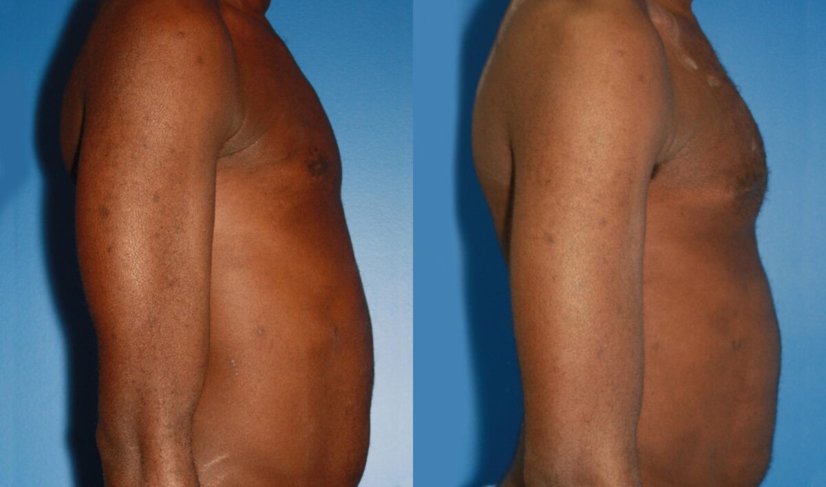 Pectoral Augmentation Before and After Photos in New York, NY, Patient 13697
