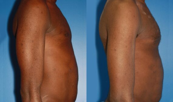Pectoral Augmentation Before and After Photos in New York, NY, Patient 13697