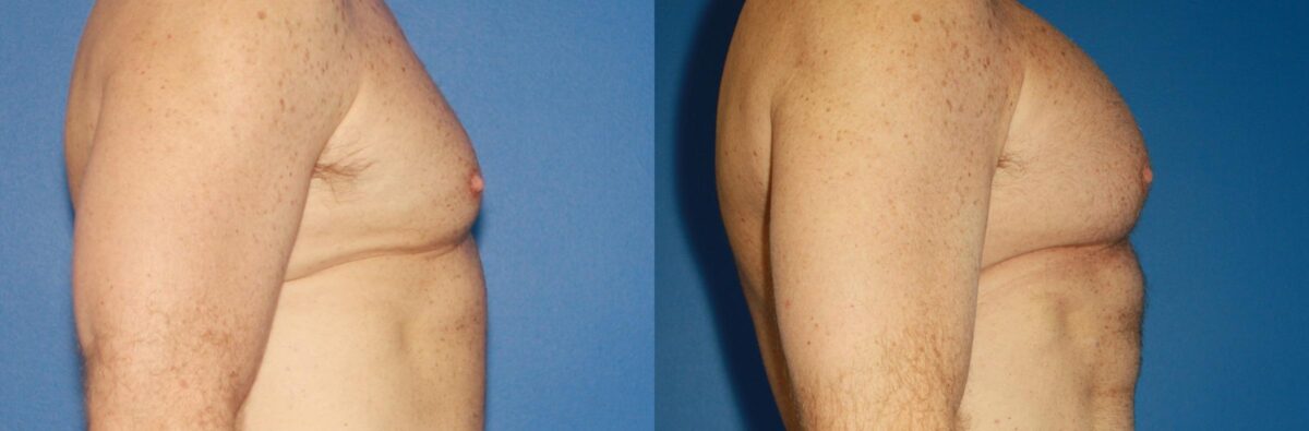 Pectoral Augmentation Before and After Photos in New York, NY, Patient 13704