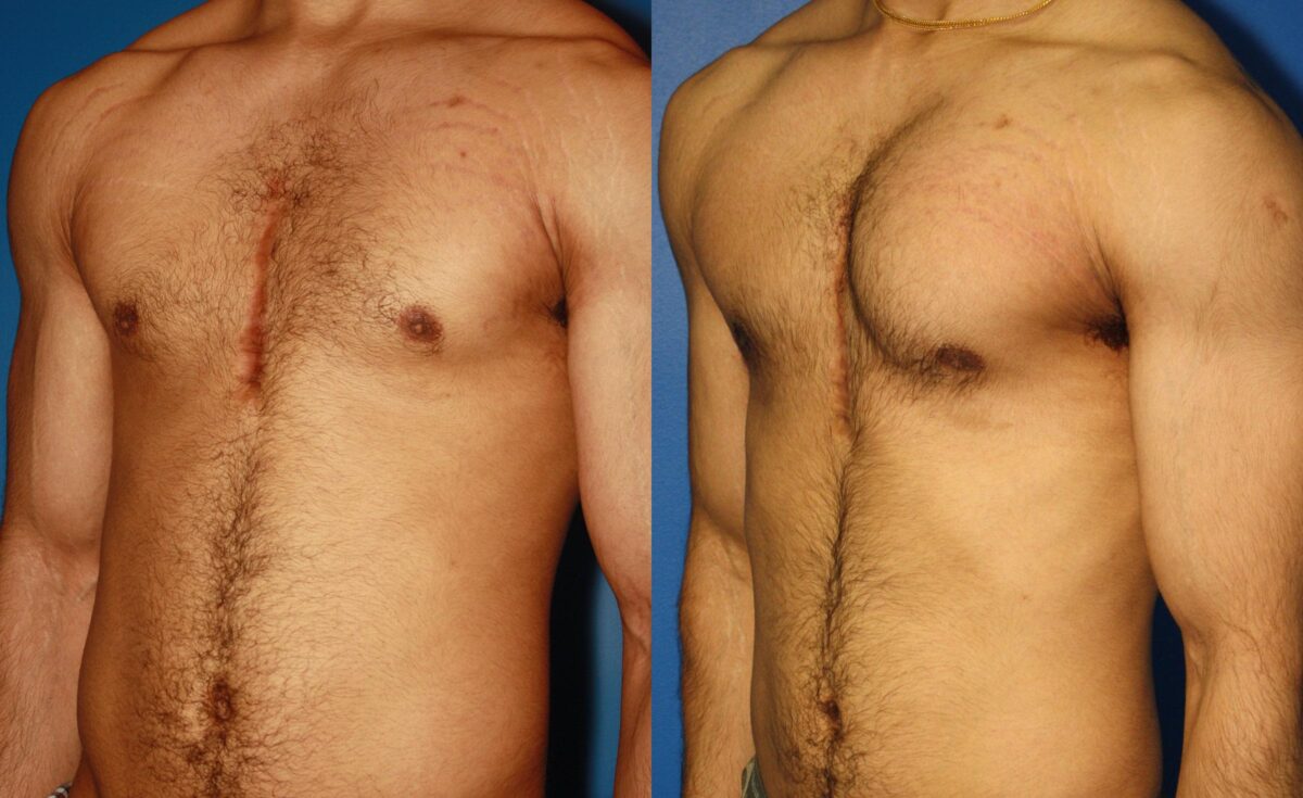 Pectoral Augmentation Before and After Photos in New York, NY, Patient 13712