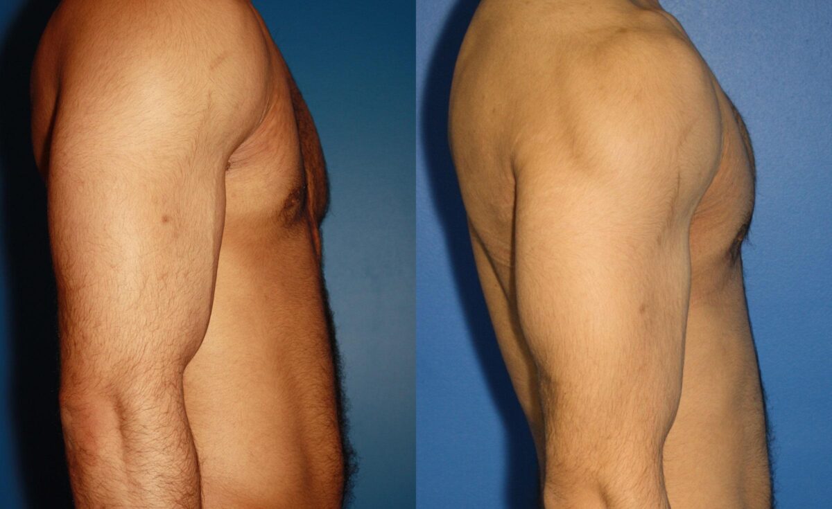 Pectoral Augmentation Before and After Photos in New York, NY, Patient 13712