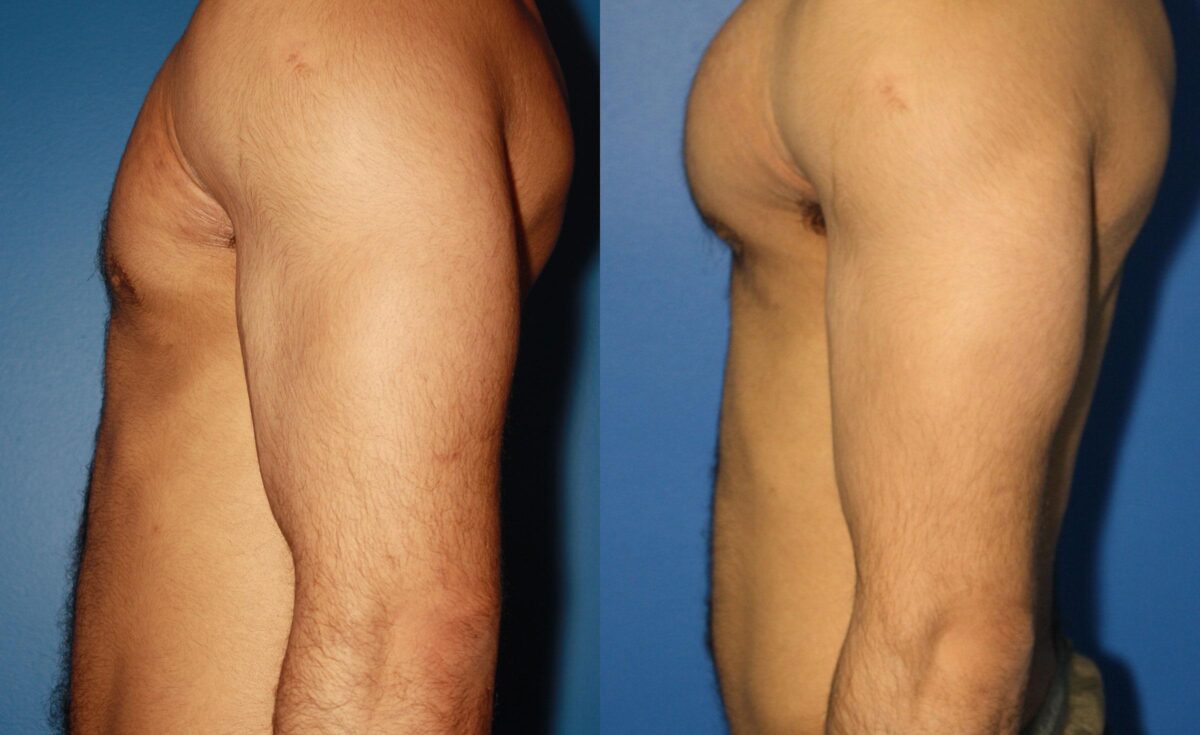 Pectoral Augmentation Before and After Photos in New York, NY, Patient 13712