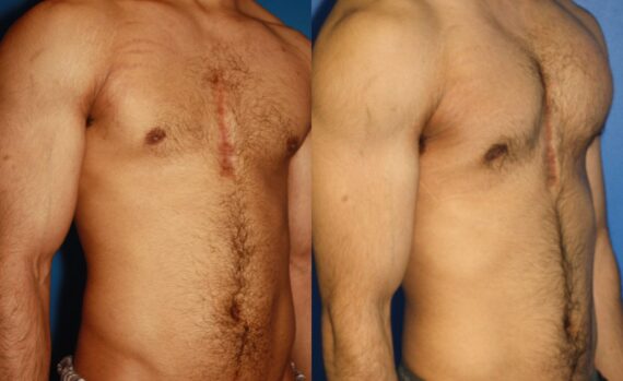 Pectoral Augmentation Before and After Photos in New York, NY, Patient 13712