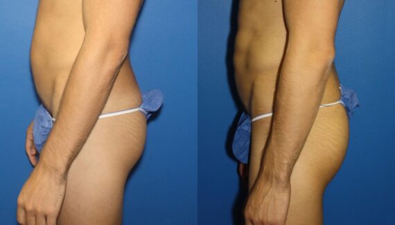 Gluteal Augmentation Before and After Photos in New York, NY, Patient 13729