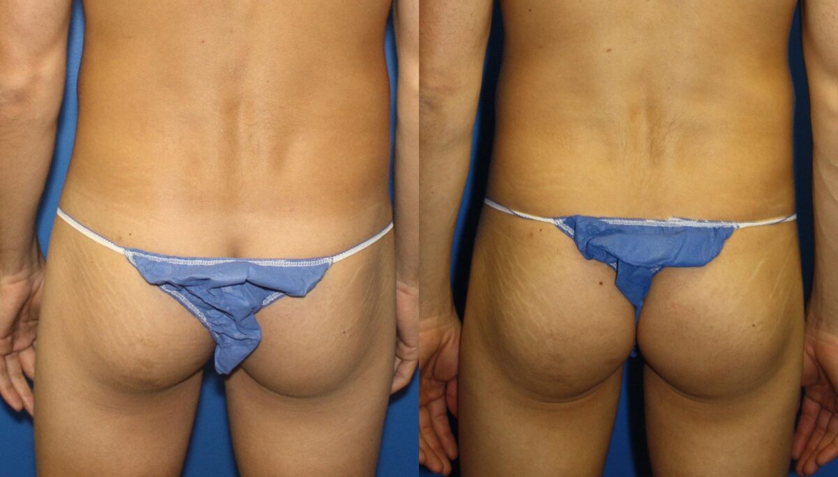 Gluteal Augmentation Before and After Photos in New York, NY, Patient 13729