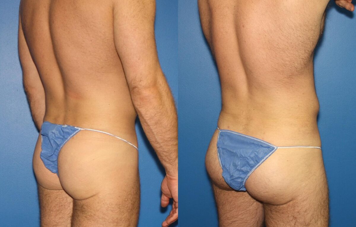 Gluteal Augmentation Before and After Photos in New York, NY, Patient 13742