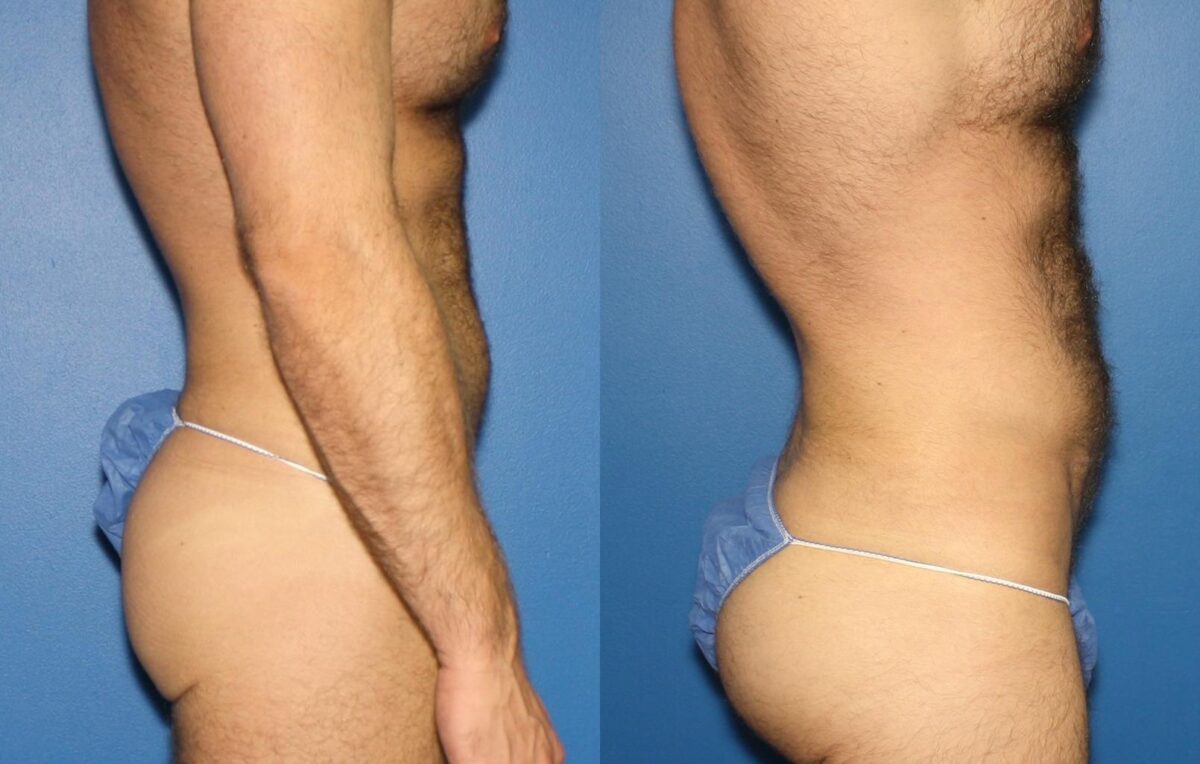 Gluteal Augmentation Before and After Photos in New York, NY, Patient 13742