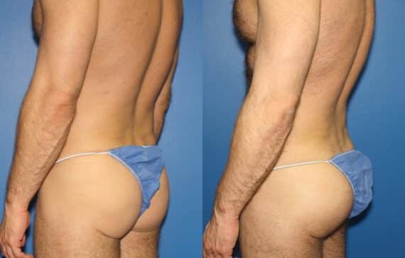 Gluteal Augmentation Before and After Photos in New York, NY, Patient 13742