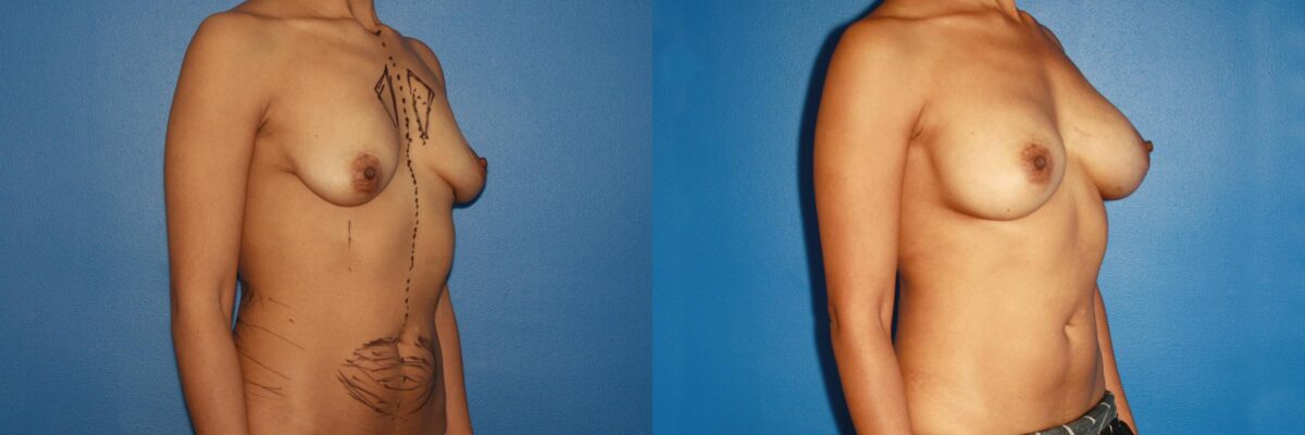 Breast Augmentation Before and After Photos in New York, NY, Patient 13756
