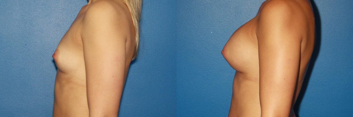 Breast Augmentation Before and After Photos in New York, NY, Patient 13774