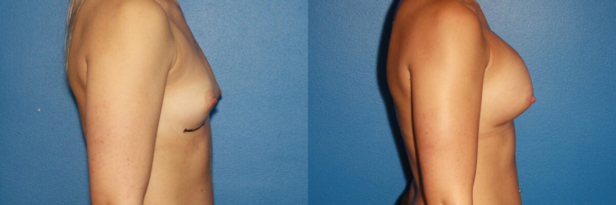 Breast Augmentation Before and After Photos in New York, NY, Patient 13774