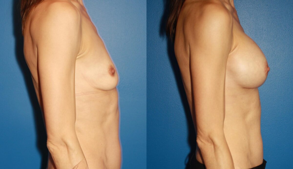 Breast Augmentation Before and After Photos in New York, NY, Patient 13790