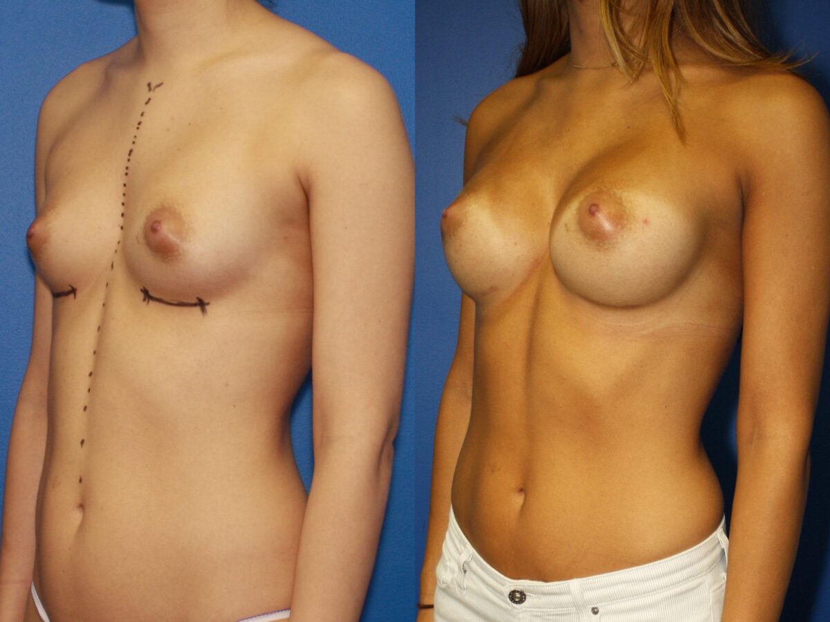 Breast Augmentation Before and After Photos in New York, NY, Patient 13822
