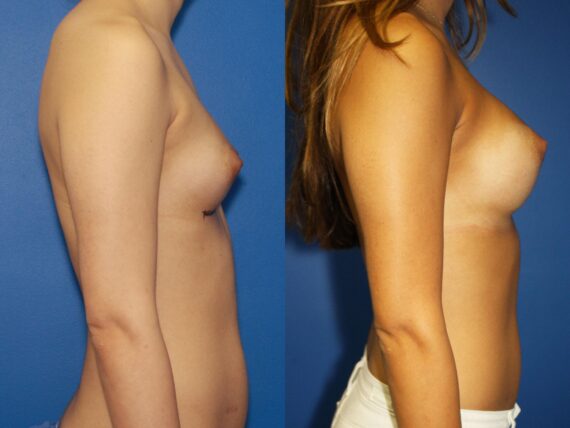 Breast Augmentation Before and After Photos in New York, NY, Patient 13822