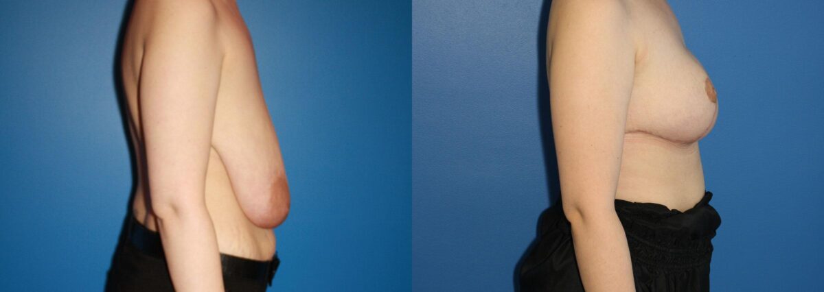Breast Augmentation Before and After Photos in New York, NY, Patient 13876