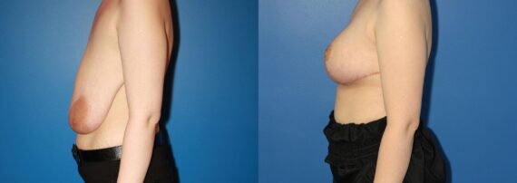 Breast Augmentation Before and After Photos in New York, NY, Patient 13876