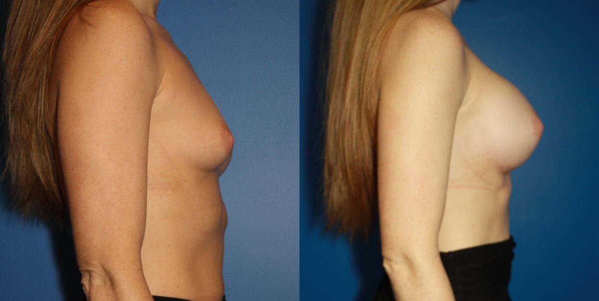 Breast Augmentation Before and After Photos in New York, NY, Patient 13908