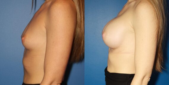 Breast Augmentation Before and After Photos in New York, NY, Patient 13908