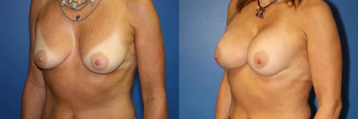 Breast Augmentation Before and After Photos in New York, NY, Patient 13942