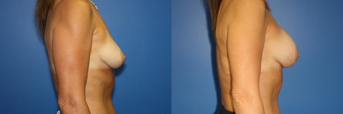 Breast Augmentation Before and After Photos in New York, NY, Patient 13942
