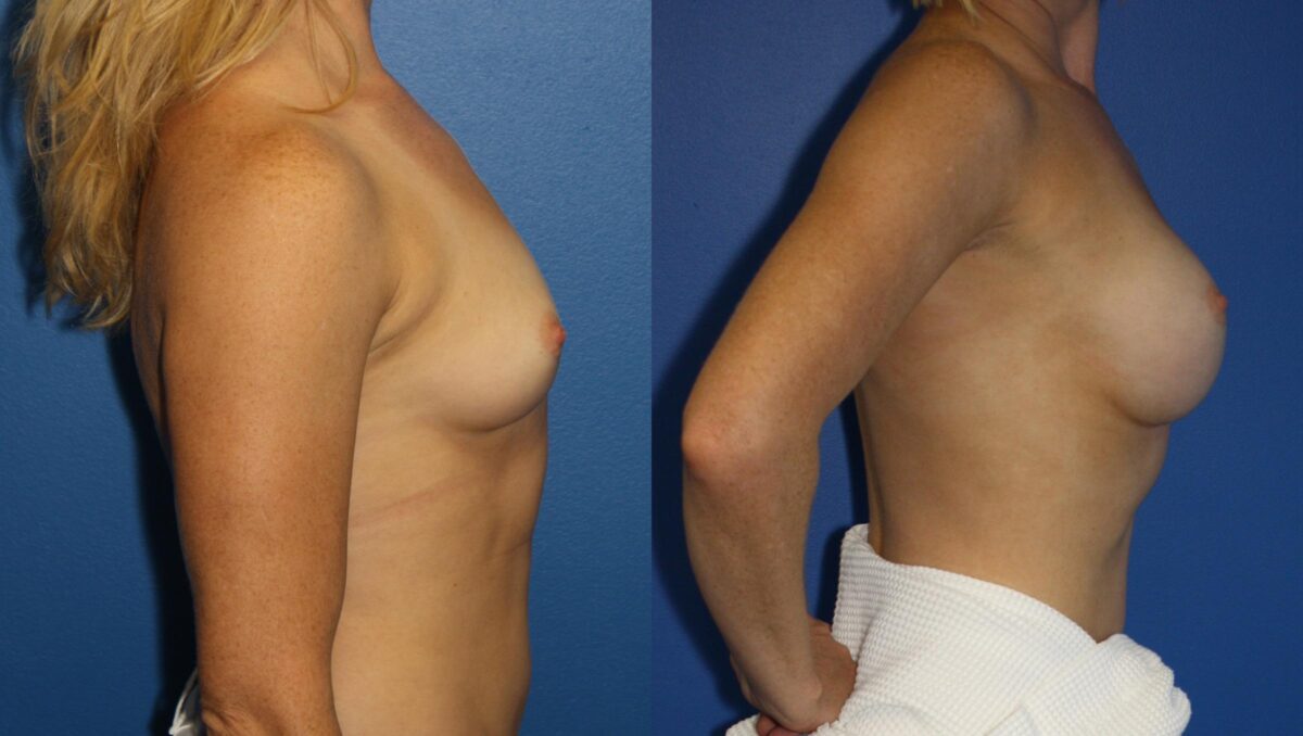 Breast Augmentation Before and After Photos in New York, NY, Patient 13959