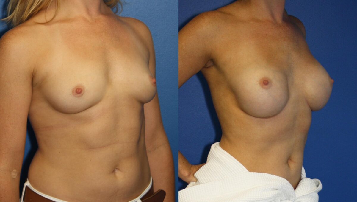 Breast Augmentation Before and After Photos in New York, NY, Patient 13959