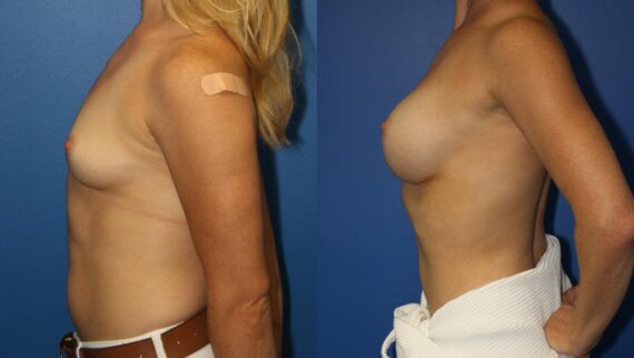 Breast Augmentation Before and After Photos in New York, NY, Patient 13959