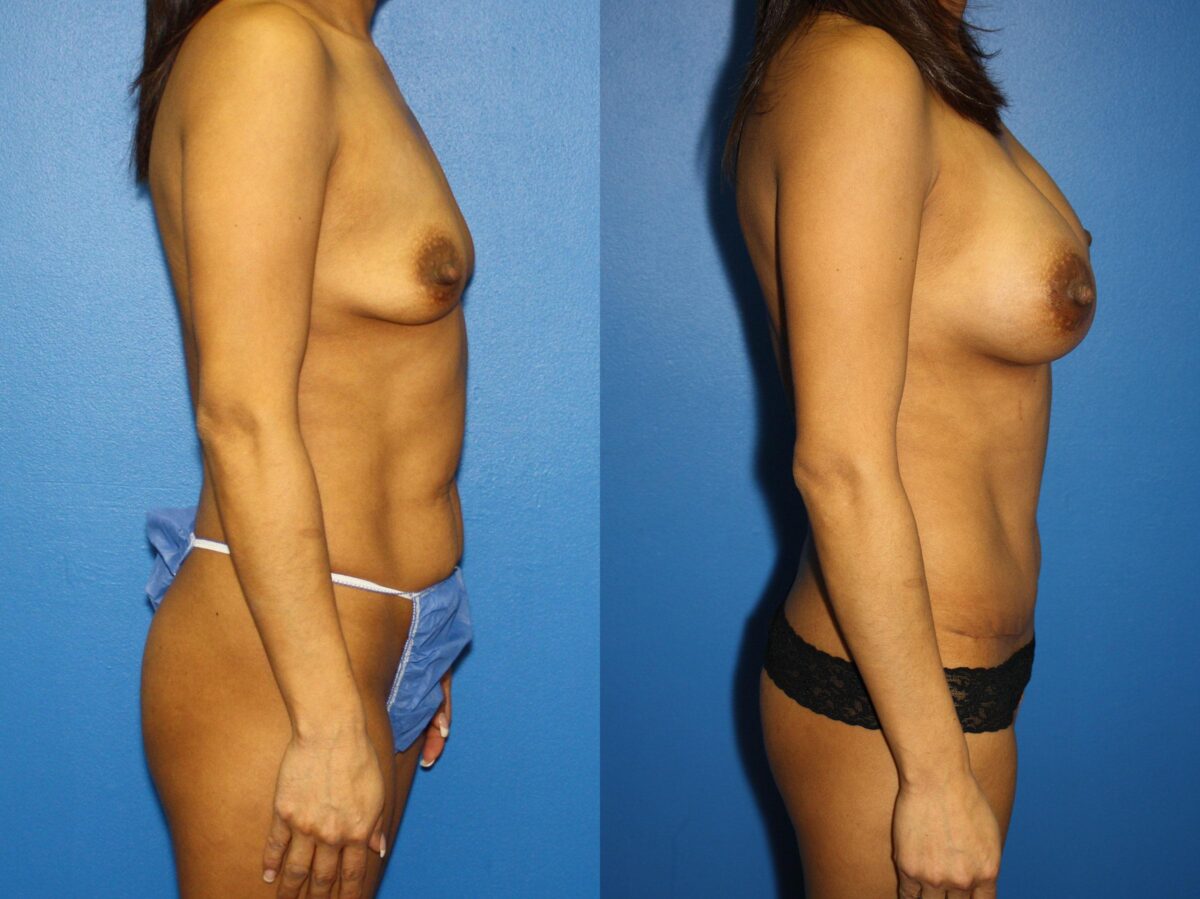 Tummy Tuck Before and After Photos in New York, NY, Patient 13995