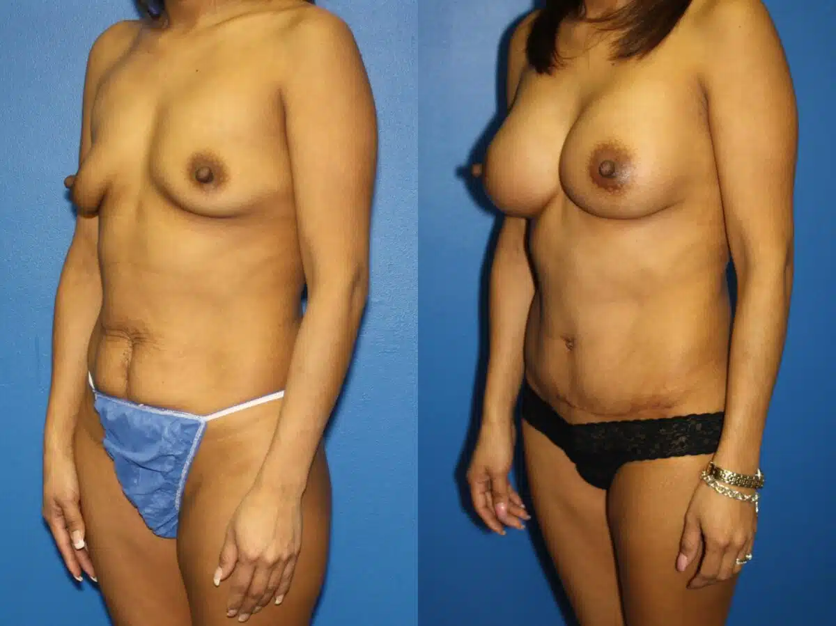 Tummy Tuck Before and After Photos in New York, NY, Patient 13995