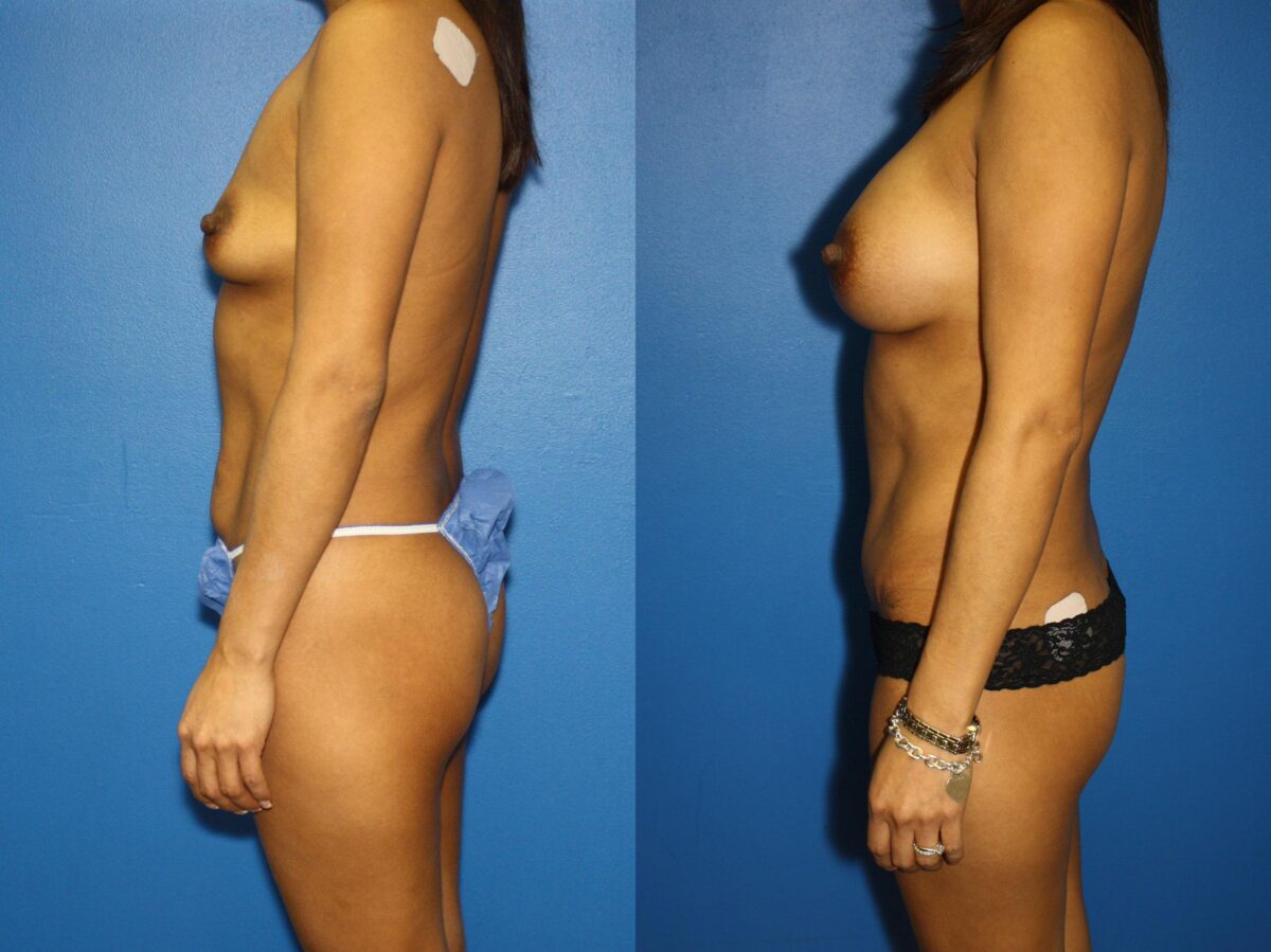 Tummy Tuck Before and After Photos in New York, NY, Patient 13995