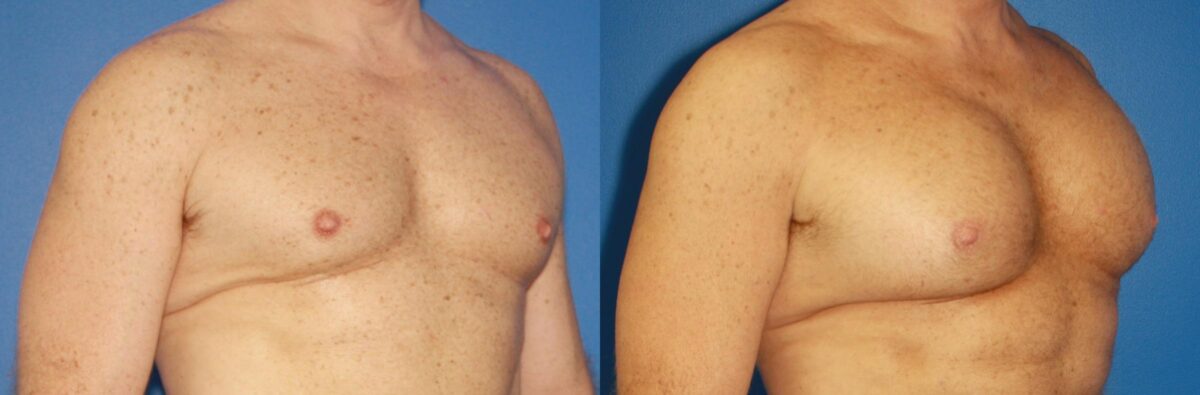 Pectoral Augmentation Before and After Photos in New York, NY, Patient 13704