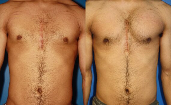 Pectoral Augmentation Before and After Photos in New York, NY, Patient 13712