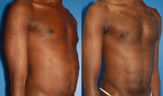 Pectoral Augmentation Before and After Photos in New York, NY, Patient 13697