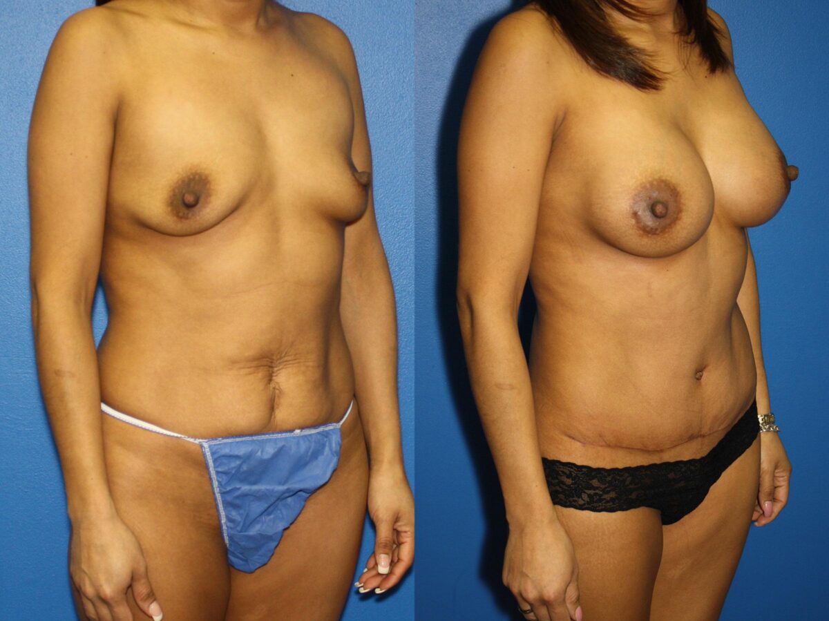 Tummy Tuck Before and After Photos in New York, NY, Patient 13995