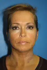 Ultrasound Short-Incision Facelift after 5 days.