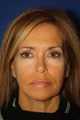 Ultrasound Short-Incision Facelift Pre-op picture.