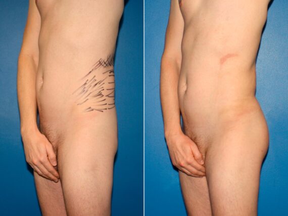 Gluteal Augmentation Before and After Photos in New York, NY, Patient 14207