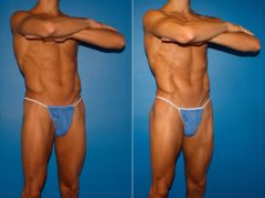 Gluteal Augmentation Before and After Photos in New York, NY, Patient 14240