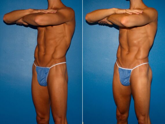 Gluteal Augmentation Before and After Photos in New York, NY, Patient 14240