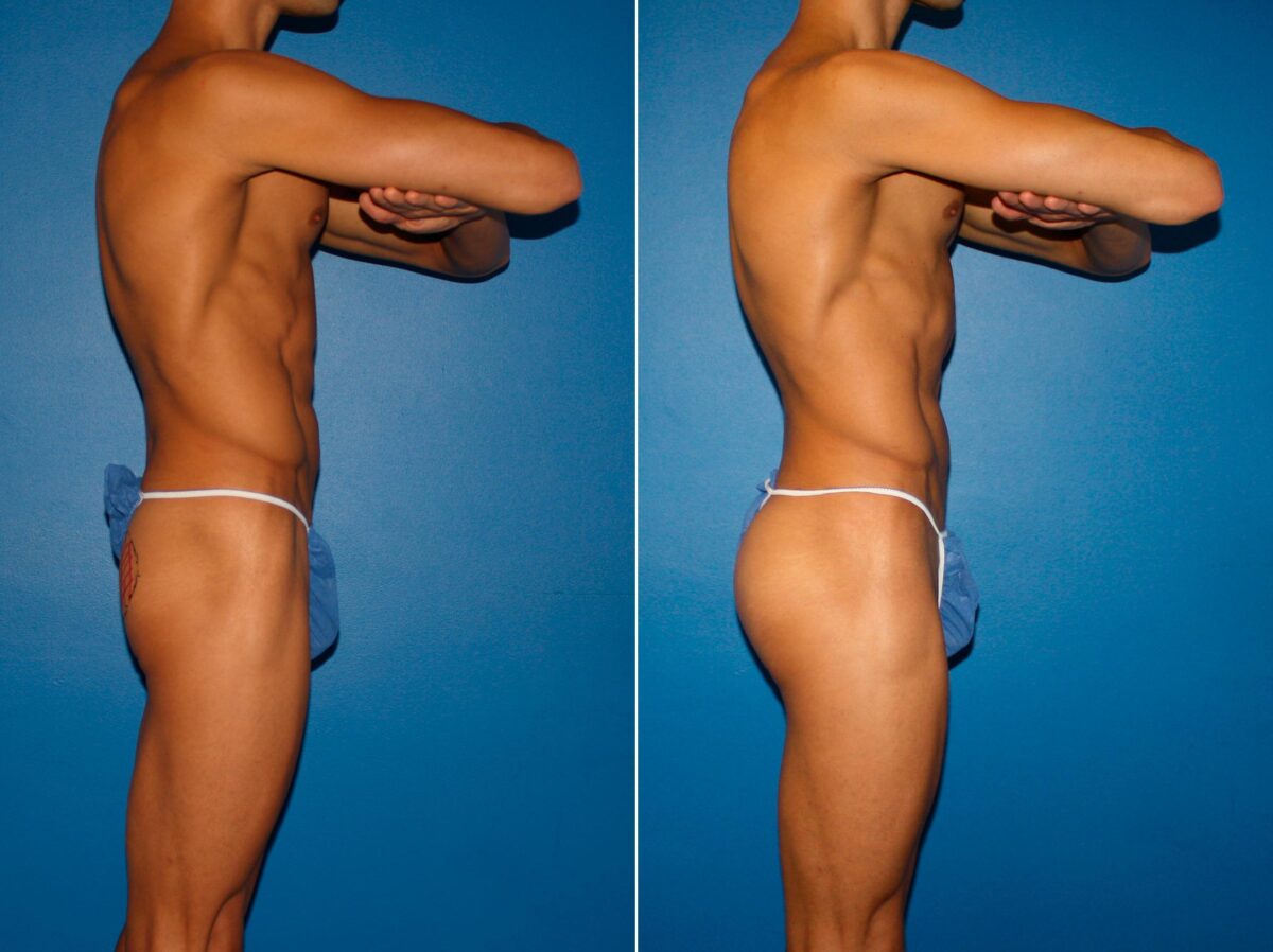 Gluteal Augmentation Before and After Photos in New York, NY, Patient 14240