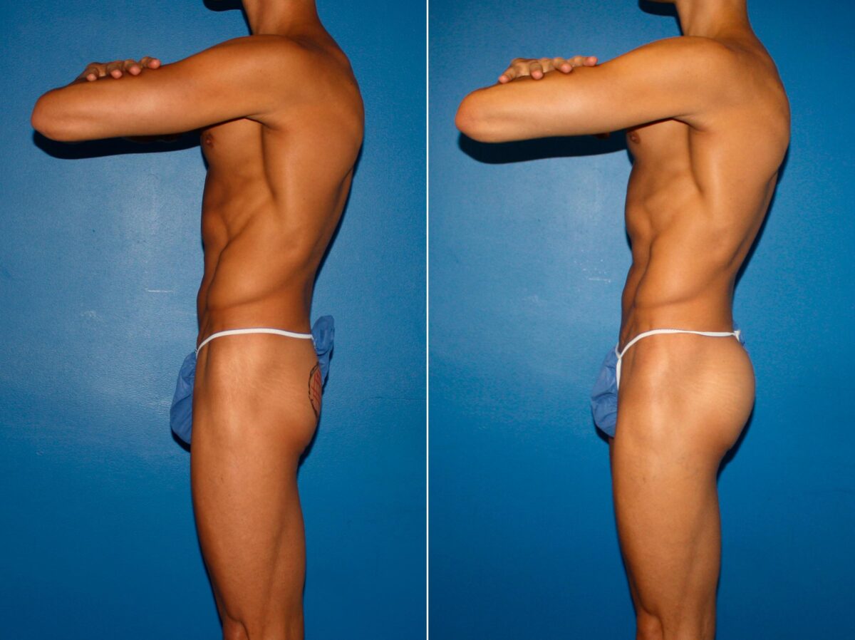 Gluteal Augmentation Before and After Photos in New York, NY, Patient 14240