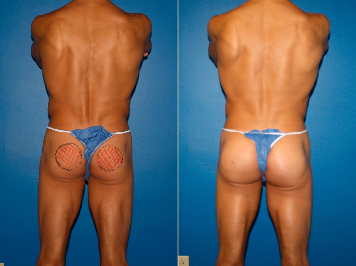 Gluteal Augmentation Before and After Photos in New York, NY, Patient 14240